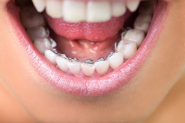 Some information on braces you didn’t know